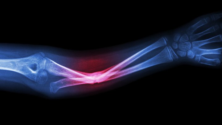 CDY-xray-broken-bones