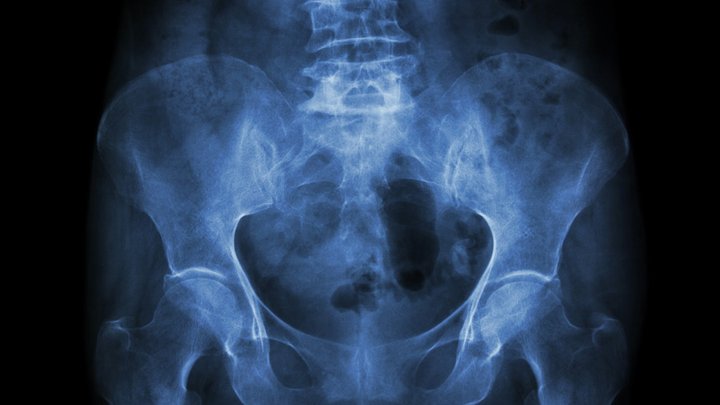 An x-ray of a pelvis