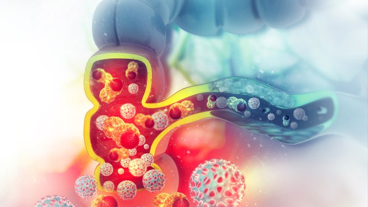 colorectal cancer.jpeg